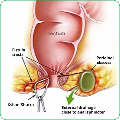 Ksharsutra Treatment